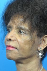 Facelift Before and After Pictures Indianapolis, IN