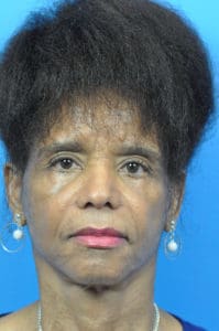 Facelift Before and After Pictures Indianapolis, IN