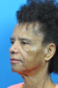 Blepharoplasty Before and After Pictures Indianapolis, IN