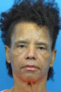Blepharoplasty Before and After Pictures Indianapolis, IN