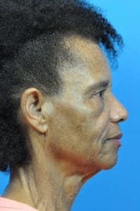 Facelift Before and After Pictures Indianapolis, IN