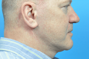 Blepharoplasty Before and After Pictures Indianapolis, IN