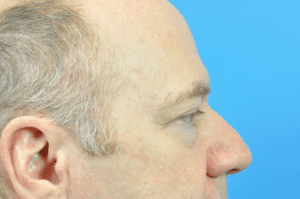 Blepharoplasty Before and After Pictures Indianapolis, IN