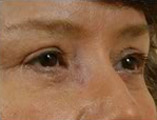 Blepharoplasty Before and After Pictures Indianapolis, IN