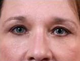 Blepharoplasty Before and After Pictures Indianapolis, IN