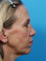 Chin Implant Before and After Pictures Indianapolis, IN