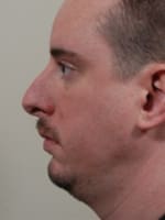Chin Implant Before and After Pictures Indianapolis, IN