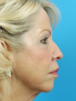 Chin Implant Before and After Pictures Indianapolis, IN