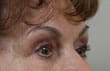 Blepharoplasty Before and After Pictures Indianapolis, IN