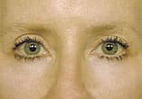 Blepharoplasty Before and After Pictures Indianapolis, IN
