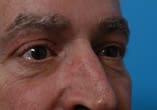 Blepharoplasty Before and After Pictures Indianapolis, IN