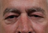 Blepharoplasty Before and After Pictures Indianapolis, IN