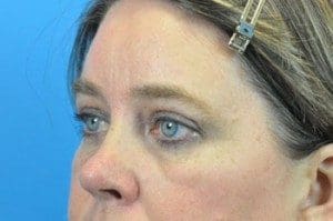 Blepharoplasty Before and After Pictures Indianapolis, IN
