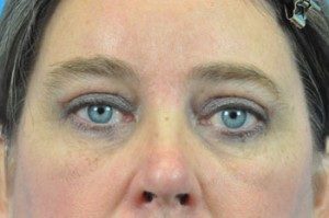Blepharoplasty Before and After Pictures Indianapolis, IN