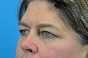 Blepharoplasty Before and After Pictures Indianapolis, IN