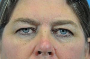Brow Lift Before and After Pictures Indianapolis, IN