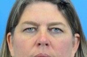 Blepharoplasty Before and After Pictures Indianapolis, IN
