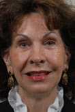 Facelift Before and After Pictures Indianapolis, IN