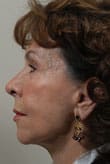 Facelift Before and After Pictures Indianapolis, IN