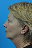 Facelift Before and After Pictures Indianapolis, IN