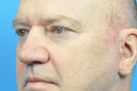 Blepharoplasty Before and After Pictures Indianapolis, IN