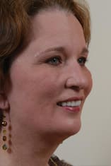 Facelift Before and After Pictures Indianapolis, IN