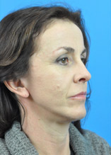 Mini Face Lift Before and After Pictures Indianapolis, IN