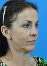 Mini Face Lift Before and After Pictures Indianapolis, IN