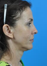Mini Face Lift Before and After Pictures Indianapolis, IN