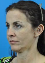 Mini Face Lift Before and After Pictures Indianapolis, IN