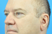 Blepharoplasty Before and After Pictures Indianapolis, IN
