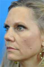 Brow Lift Before and After Pictures Indianapolis, IN