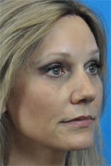 Brow Lift Before and After Pictures Indianapolis, IN