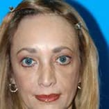 Brow Lift Before and After Pictures Indianapolis, IN