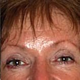 Brow Lift Before and After Pictures Indianapolis, IN