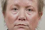 Brow Lift Before and After Pictures Indianapolis, IN