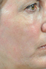 Fractional Laser Resurfacing Before and After Pictures Indianapolis, IN