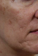Fractional Laser Resurfacing Before and After Pictures Indianapolis, IN