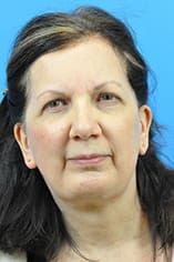 Facelift Before and After Pictures Indianapolis, IN
