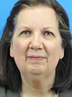 Chin Implant Before and After Pictures Indianapolis, IN