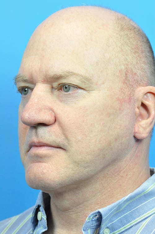 Facelift Before and After Pictures Indianapolis, IN