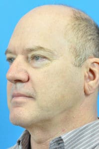 Facelift Before and After Pictures Indianapolis, IN