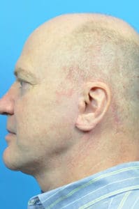 Facelift Before and After Pictures Indianapolis, IN