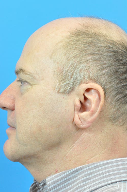 Facelift Before and After Pictures Indianapolis, IN