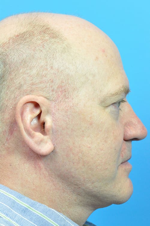 Facelift Before and After Pictures Indianapolis, IN
