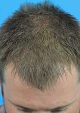 Hair Transplant Before and After Pictures Indianapolis, IN