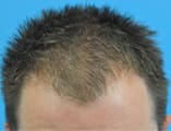 Hair Transplant Before and After Pictures Indianapolis, IN