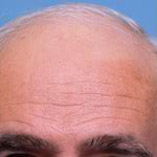 Hair Replacements Before and After Pictures Indianapolis, IN