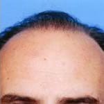 Hair Transplant Before and After Pictures Indianapolis, IN