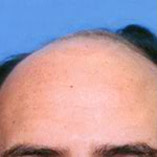 Hair Transplant Before and After Pictures Indianapolis, IN